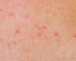 Genital Herpes Market Epidemiology Report 2025-2035: Pipeline Therapies, Drugs Sales, and Regional Outlook