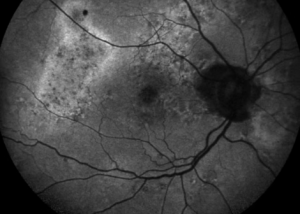 Greyscale retinal image showing vessels and macula