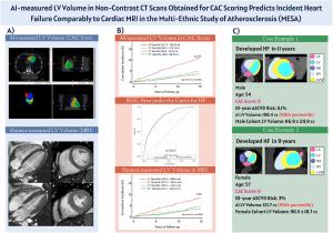 A new peer-reviewed study published in JCCT (Journal of Cardiovascular Computed Tomography) reports that an artificial intelligence (AI) algorithm can opportunistically measure the left ventricular (LV) chamber on routine non-contrast chest CT scans and predict future heart failure as accurately as cardiac MRI 23426618 fig 1 ai measured left ventri