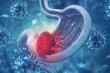 HER2+ Gastric Cancer Therapy Market Set for Steady Growth by 2033 | DataM Intelligence