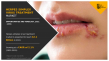 Global Herpes Simplex Virus Treatment Market: Growth, Trends, and Opportunities to 2031