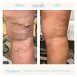 Increased Vein Symptoms in Summer Prompt Call for Early Screenings