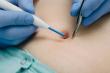 Naples Laser & Skin Aesthetics Provides Safe Lesion Removal in Naples, FL