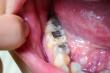The PDHA Urges FDA to Ban Mercury Amalgam Fillings & Support Ethical Dentists