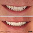 The Future of Veneers Is Here: Dr. Joyce Kahng Partners with Neer for No-Prep Innovation