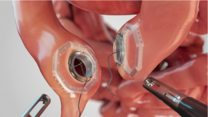 Forming the anastomosis