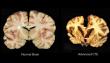 Chinese Neurosurgical Journal Study Urges Attention to Africa’s Chronic Traumatic Encephalopathy Research Deficit