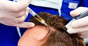 Unlocking hair growth with PRP therapy