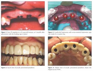 Fixed Implant supported prostheses - from a study by Dr. Peter Taylor