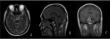 Chinese Neurosurgical Journal Study Reviews Rare Form of Central Nervous System Tumors