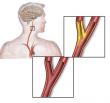 Chinese Neurosurgical Journal’s Article Examines the Effects of Carotid Endarterectomy on the Blood-Brain Barrier