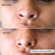 The Rise of the Needle: Why Non-Surgical Nose Jobs Are Beating the Knife
