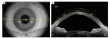 Mapping fluid reservoir dynamics in scleral lens wear