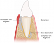 Cracks Beneath the Surface: New Consensus Sheds Light on Cemental Tear