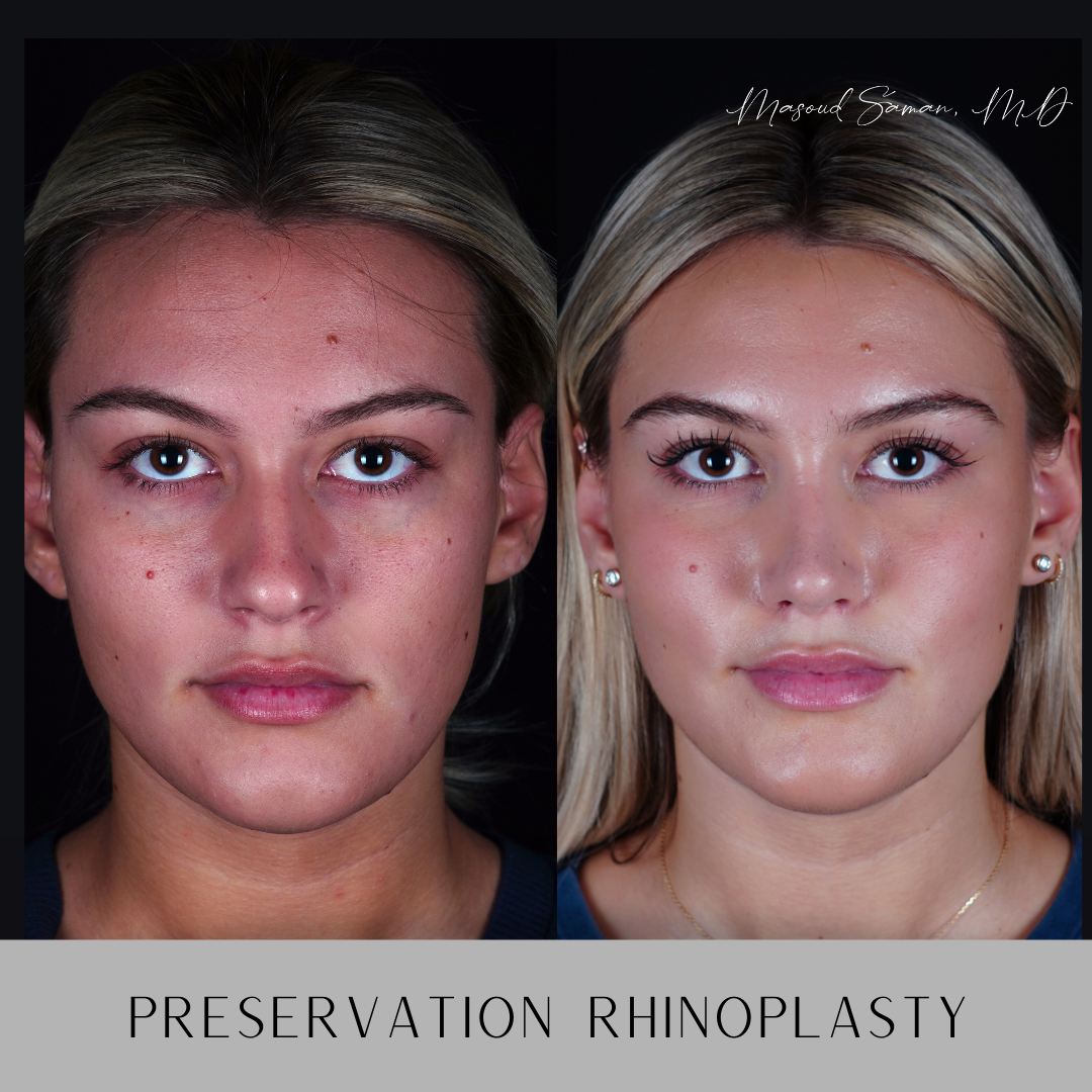 健康・医学 Preservation Rhinoplasty 健康・医学 Preservation Rhinoplasty Preservation Rhinoplasty
