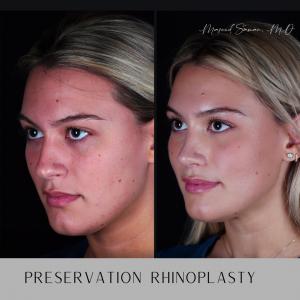 Before and after 3/4 view of rhinoplasty performed by Dr. Masoud Saman in New York City, highlighting natural, elegant, and refined results.