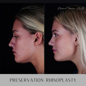 Side profile ultrasonic rhinoplasty by Masoud Saman said by some to be the best rhinoplasty surgeon in the world