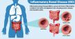 LogsDay Analyzes IBD Life Expectancy: Can You Live a Full Life with the Condition?