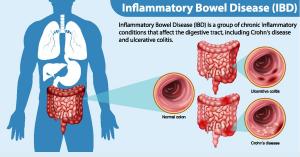 Can You Live a Full Life with IBD What Life Expectancy Looks Like