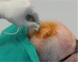 RBI Advances World’s First Direct-to-Brain Autologous Stem Cell Therapy for Alzheimer’s Into Phase 2 Clinical Trial