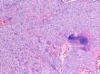 Unfolded Protein Response pathway offers new targets to treat bone weakness in cancer patients