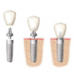 AIHW Reports 4.9% of Adults Experience Tooth Loss from Decay, Dental Implants Provide Relief