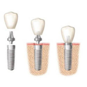 Dental Implants Sydney