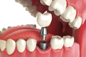 Wisdom teeth removal sydney