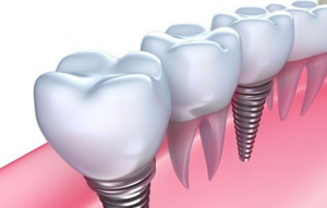 Teeth Whitening Sydney