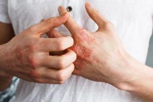 October is National Eczema Awareness Month 15 Hand Eczema