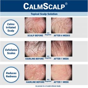 Before and after photos showing how CalmScalp improves scalp and hairline with flakes, redness and irritation without steroids., based on a clinical study. The results were achieved between one and six weeks of treatment, depending on the condition.