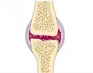 Cpla2 cPLA2 Inhibition with Fexofenadine Protects Cartilage in Degenera