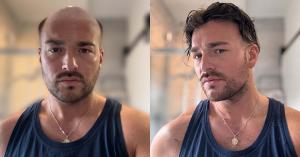 Lordhair Hair System Before and After Photo