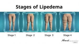Stages of Lipedema