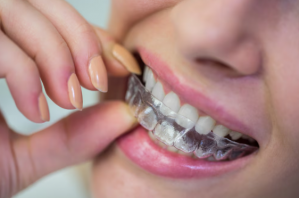 Invisalign treatment Santa Monica