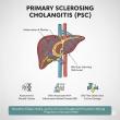 Primary Sclerosing Cholangitis Market Poised for Breakthrough Growth as Novel Therapies Enter Clinical Spotlight 2025-32