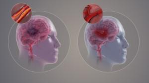 Neuroform Atlas Stent-assisted coiling approach from intracranial aneurysms