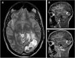 Chinese Neurosurgical Journal Reports Rare Hematoma Following Cyst Formation After AVM Radiosurgery 
