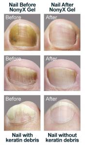 SEt of three toenails before and after using NONYX