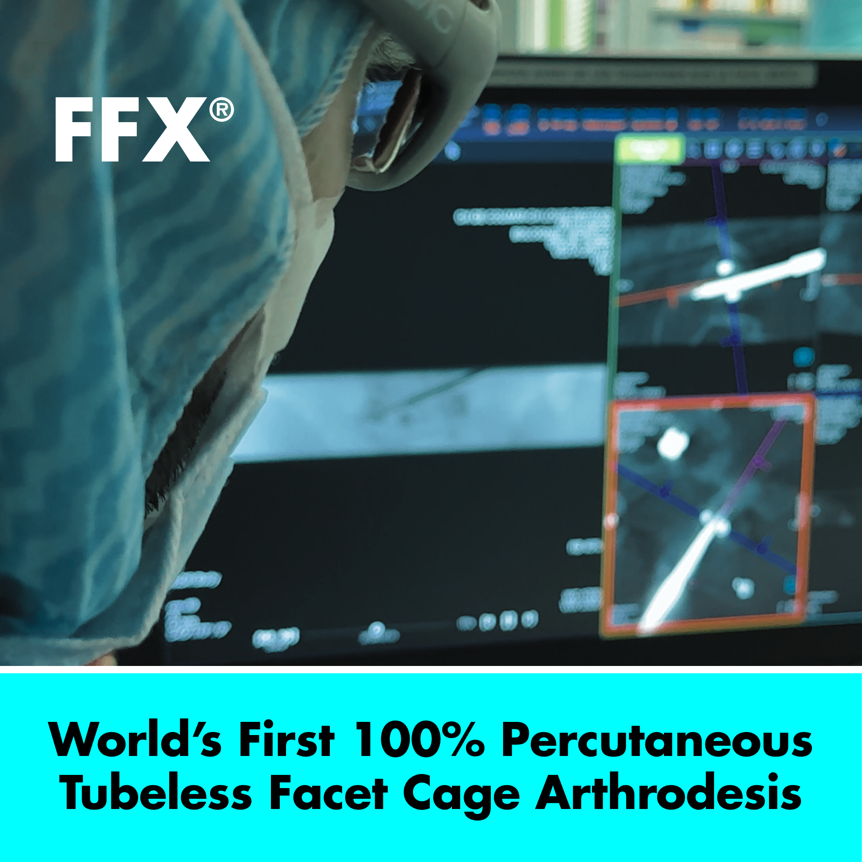 SC MEDICA Announces World’s First 100% Percutaneous, Tubeless Facet Cage Arthrodesis