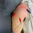 Trigger Point Therapy with Dry Needling is the Future of Physical Therapy