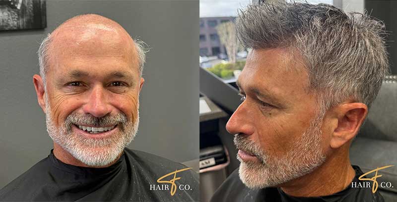 Fidenza Hair Co. Establishes New Standard for Non-Surgical Hair Restoration and Trichology in San Diego