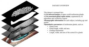 From images to insight: AI builds the first pediatric reference map for meibomian glands 7 24696225 fig 1 overview of the children