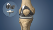Knee Reconstruction Devices Industry Growth at 4.9% CAGR Through 2033 | Persistence Market Resaerch