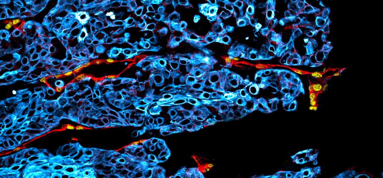Aggressive oral cancer can be identified at an early stage by changes in lymphatic vessels