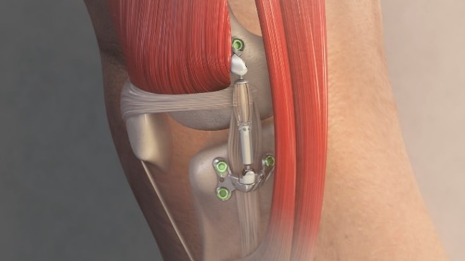 Arthroscopy Association of North America Advocacy Helps Expand Access for Innovative Orthopedic Treatment