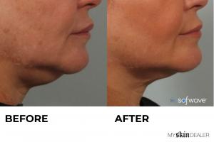 Sofwave™ Before & After #1