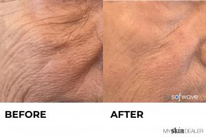 Sofwave™ Before & After #2