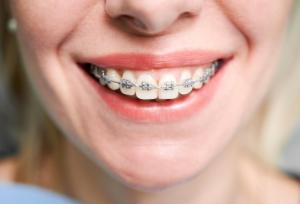 Recent industry data and local clinical observations indicate a measurable rise in the demand for dental braces in Los Angeles Dental Braces in Los Angeles