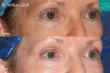 Cosmetic Laser Dermatology Announces First Non-Surgical Treatment to Reverse 10+ Years of Aging Around the Eyes